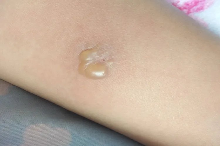 PPD硬结直径测量图解