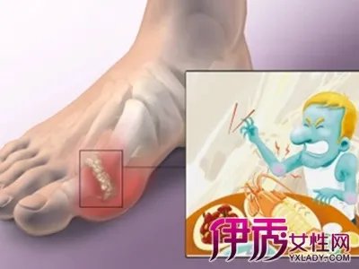 人体血尿酸高的原因和危害有哪些