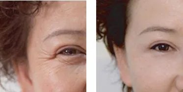 玻尿酸除皱的价格