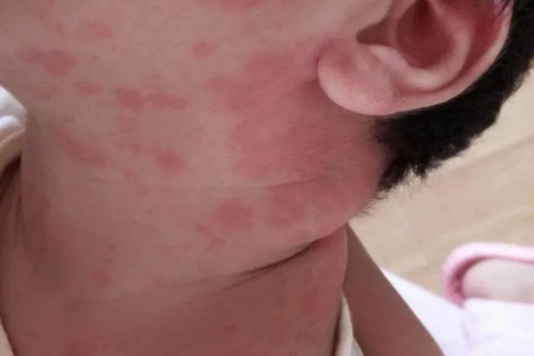 芝士过敏症状图