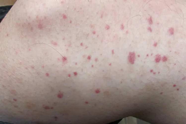 炭疽败血症症状图片