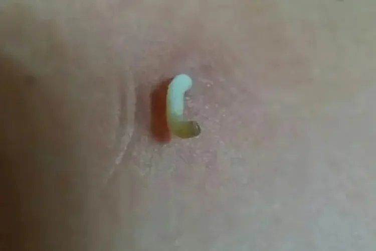 腋窝下疙瘩挤出黄黄的东西图片