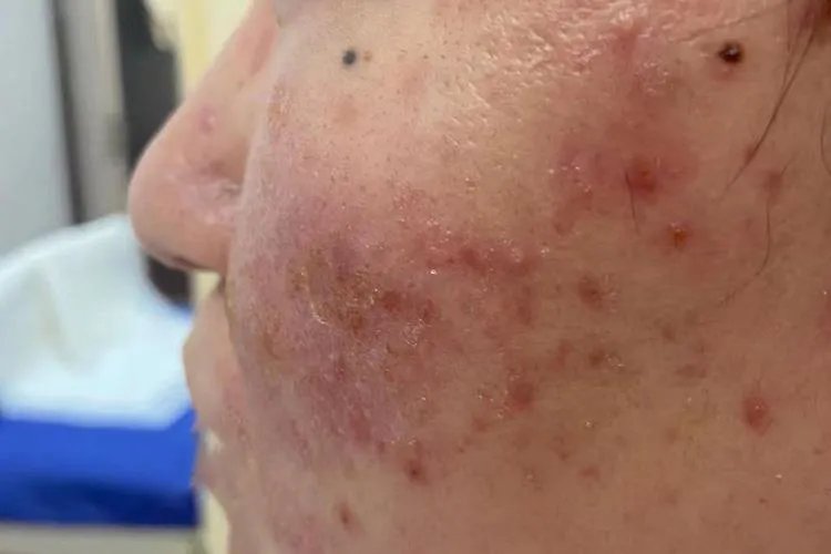 火龙果过敏症状图片大全