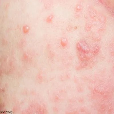 过敏性皮肤病的治疗药物哪种常用