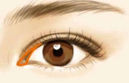 割双眼皮开内眼角好还是外眼角好