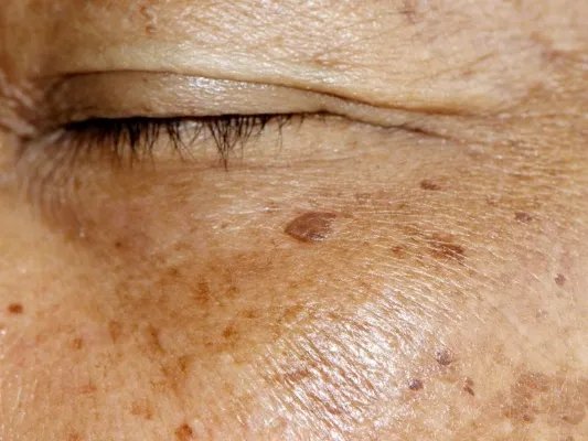 怎样预防黄褐斑