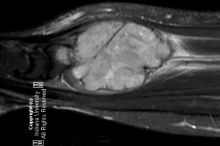 尤文肉瘤真实图片