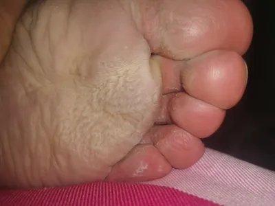 窝状角质松解症脚底松弛图片