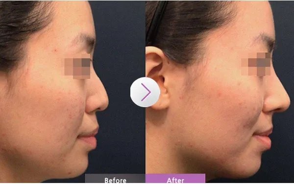 韩式隆鼻整形手术需要多少钱