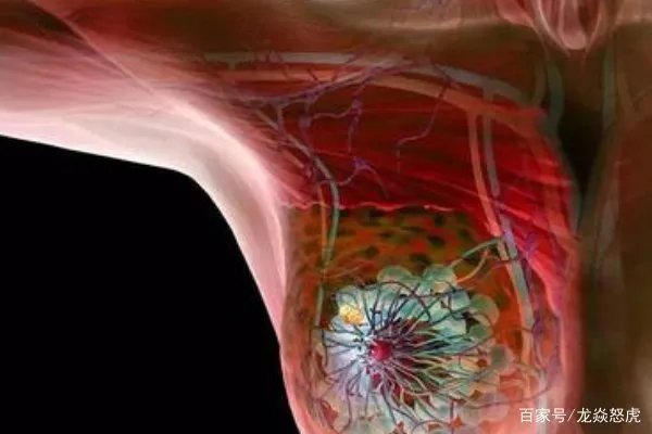 姚贝娜乳腺癌早期为什么只活了三年？