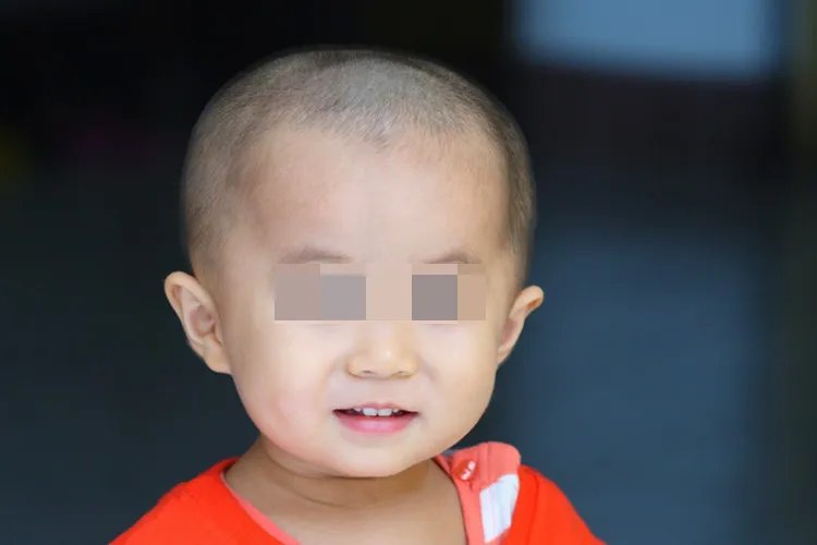 宝宝额头骨头凸起图片