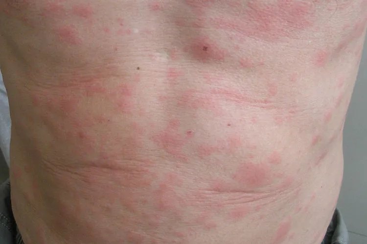 输液过敏全身痒起红疙瘩图片