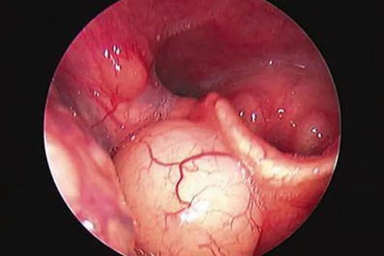 芝士过敏症状图