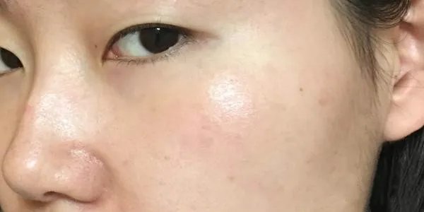 激光嫩肤有副作用吗