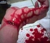 c.k沉珂的自残照片,