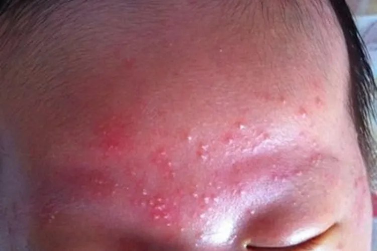 新生儿脸上长红疹子有白头图片