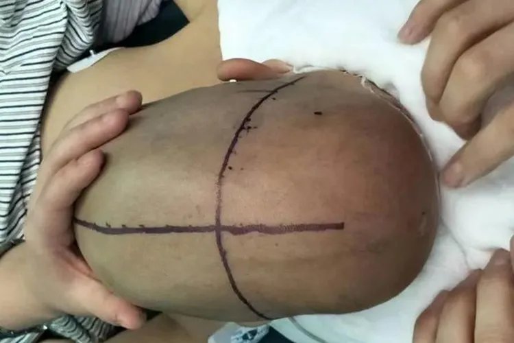 宝宝额头骨头凸起图片