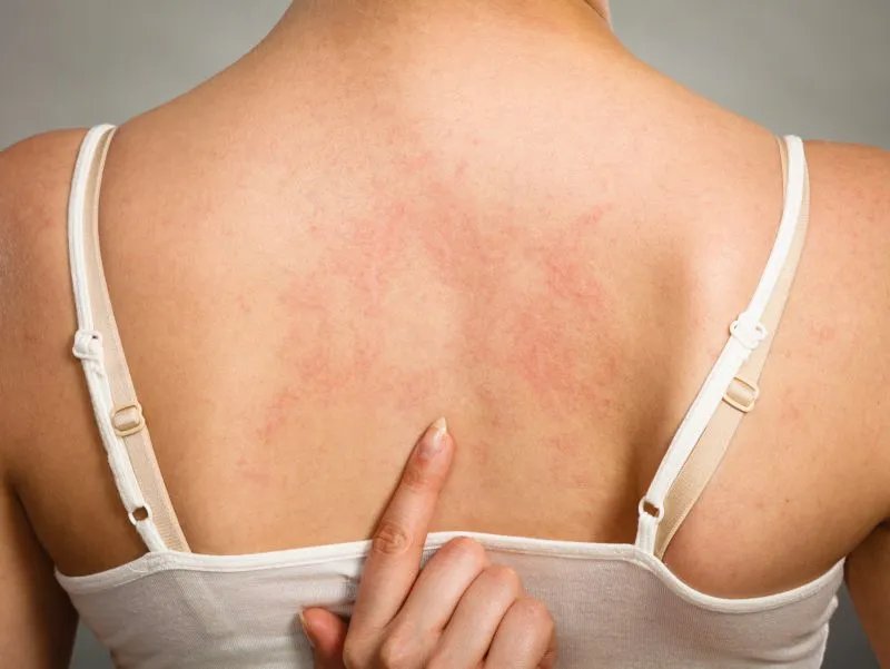 荨麻疹能彻底治好吗