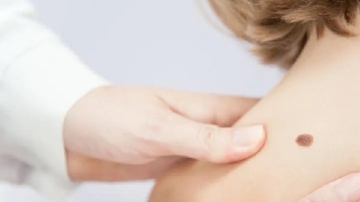 脸上痘痘怎么去除